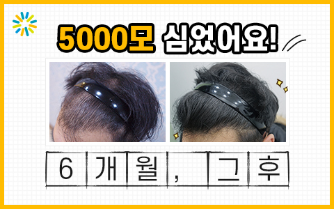 5000모 모발이식 6개월 후 유튜브 바로가기